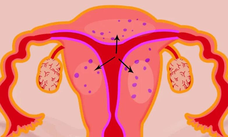 弥漫性子宫腺肌症能做试管吗？弥漫性腺肌症能生孩子吗？
