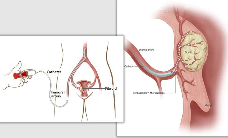 有子宫腺肌症做试管成功率高吗？子宫腺肌症怎么生孩子？