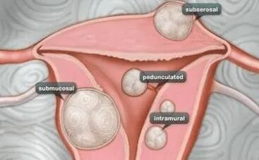 有腺肌症和腺肌瘤能做试管吗？腺肌症试管可行吗？