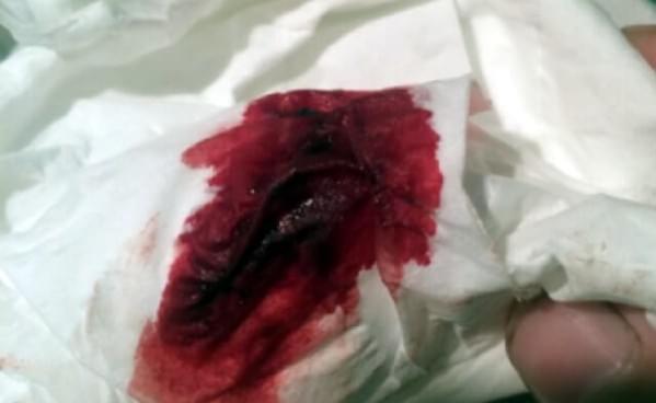 试管移植失败后18天有暗红色血块流出正常吗？看完这篇就明白了