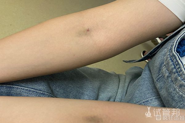 银川市中医医院第二代试管婴儿日记之打夜针