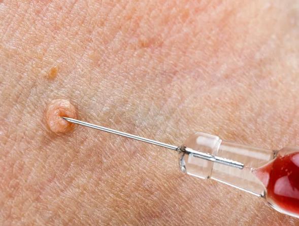 女性有假性尖锐湿疣可以进行试管移植吗?