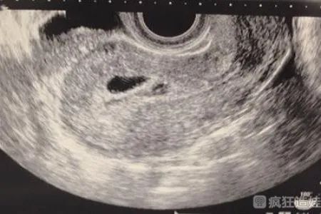 移植多久可以看到孕囊？移植看到孕囊在什么时候？