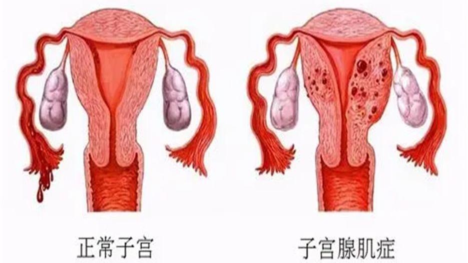 腺肌症有通过试管怀孕成功的案例吗？看实际案例了解