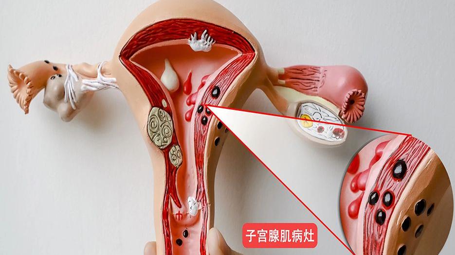 2022子宫腺肌症试管促排方案选择指南，长方案也许更适合