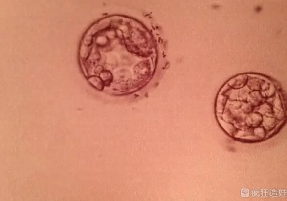 杭州市妇幼第三代试管婴儿选性别费用多少钱？附费用明细？