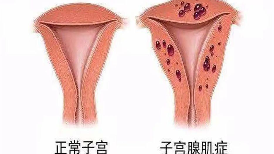 腺肌症做试管是先取卵还是打针？权威答案来啦