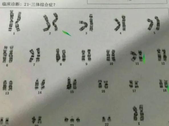 21三体先天愚型可以做第三代试管婴儿实现生孩子吗？