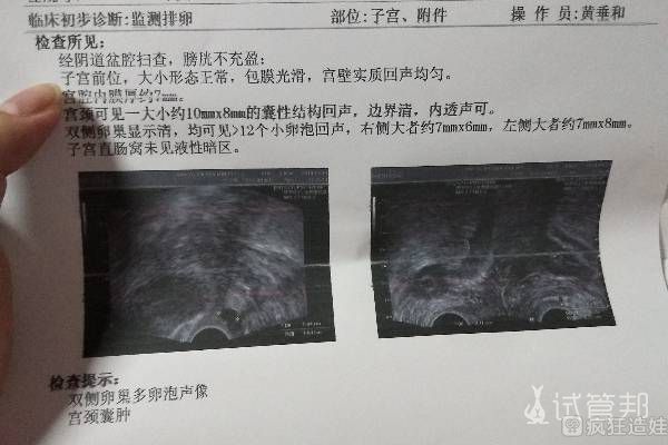 海南第二代试管婴儿收获一对双胞胎，试管经验总结一定要看