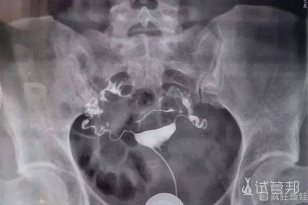 检查出双侧输卵管堵塞, 在兰州大学第一医院第二代试管婴儿成功