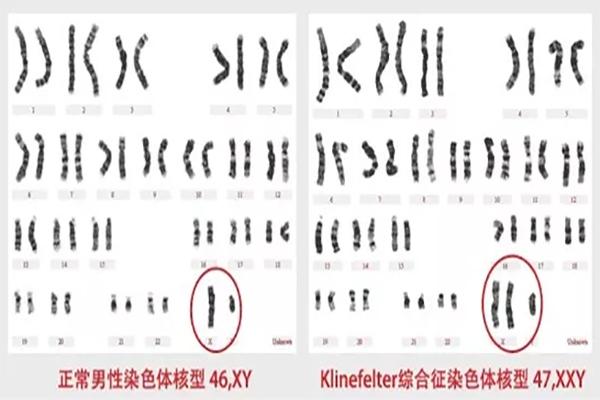 克氏综合征可以做试管婴儿吗？三代试管是首选，可阻断遗传给后代