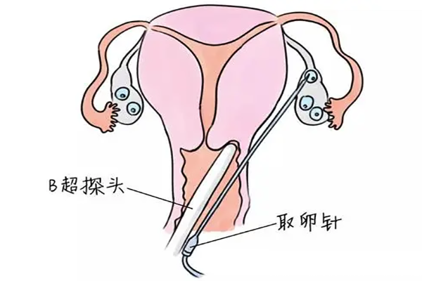 取卵后腹水的高峰期时间-症状-预防-处理方法-注意事项