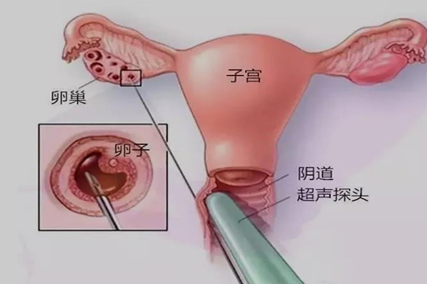 揭秘试管婴儿取卵手术过程-7个步骤仅需10-20分钟