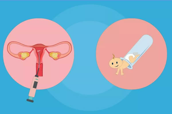 专家解析供精人工授精和供精试管婴儿的区别，看完就知道该如何选择了