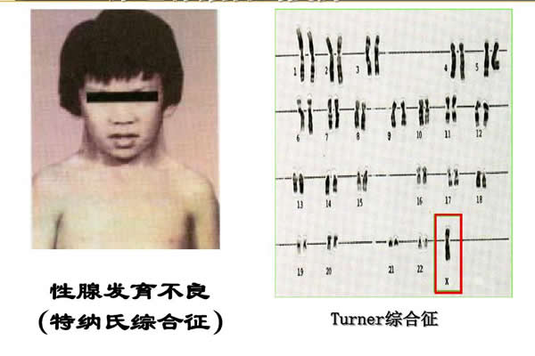 专家答疑特纳综合征可以做试管婴儿吗，一看就明白