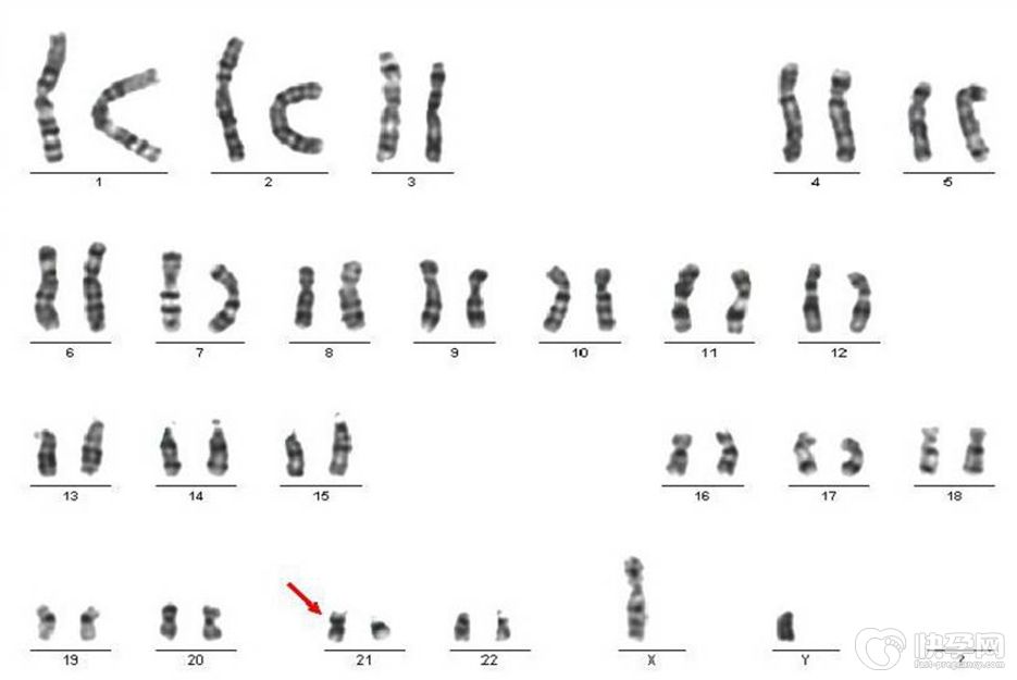 生过唐氏综合征再生育该如何避免唐氏儿，第三代试管婴儿是最优选择