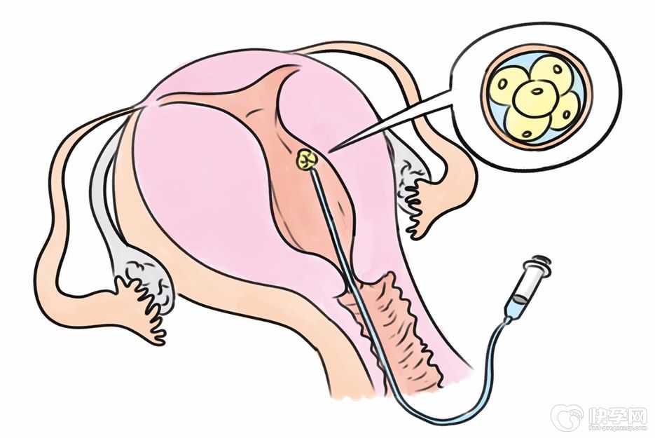 试管婴儿取卵一般取多少个比较好