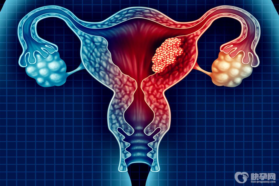 子宫内膜结核可以做试管吗？专家解读子宫内膜结核