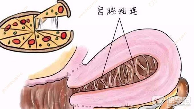 女性宫腔粘连可以做试管婴儿吗？看完你心里就有谱了