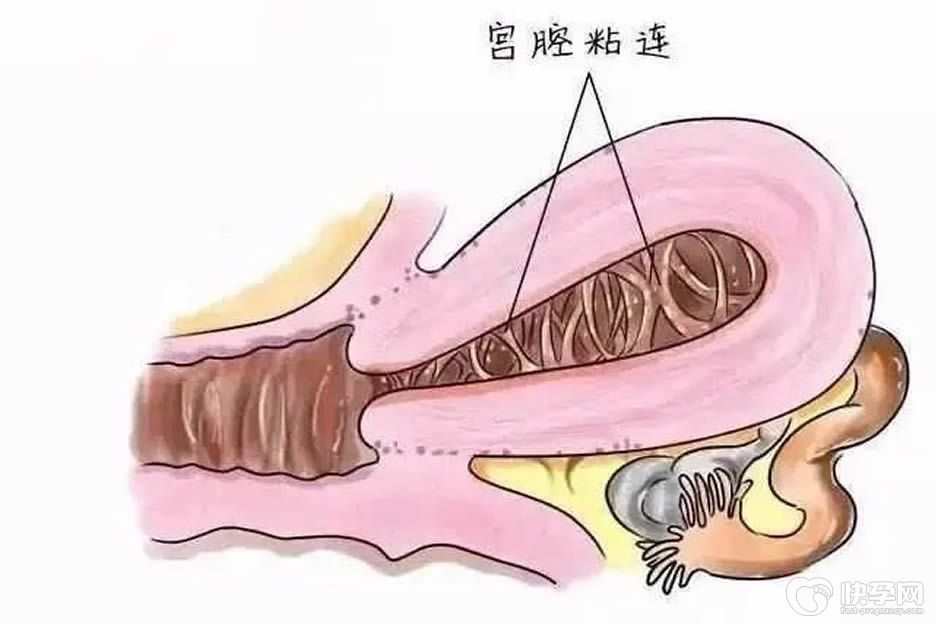 宫腔局部粘连影响试管婴儿吗-具体位置不同影响不同