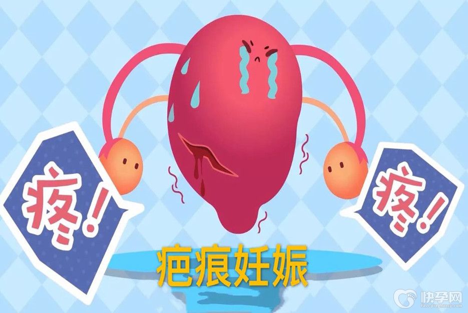 做试管婴儿能避免疤痕妊娠吗？预防疤痕妊娠的6个方法