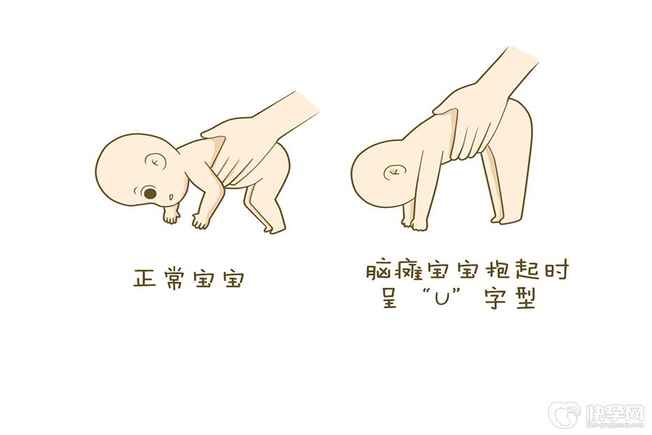 如何避免试管婴儿宝宝得脑瘫？需要牢记这4点