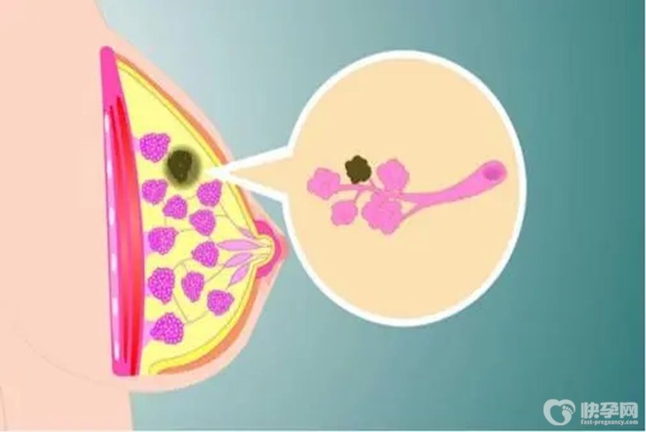乳腺结节3类可以做试管婴儿吗？依据自身情况谨慎选择
