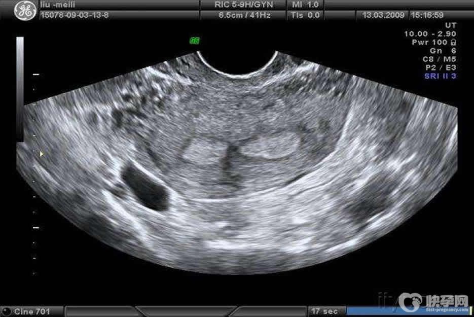 子宫纵隔可以做试管婴儿吗？是否严重是关键