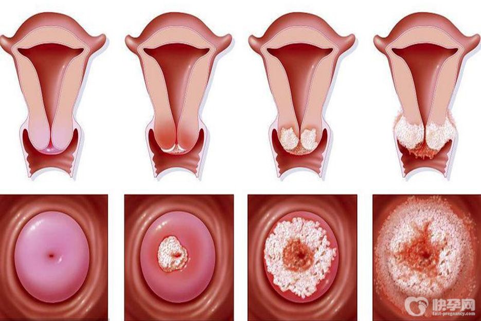 宫颈糜烂3度能做试管吗？病理性宫颈糜烂还需先治疗