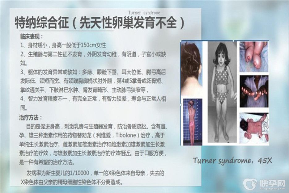 权威专家带你了解嵌合型特纳综合征能做试管婴儿吗