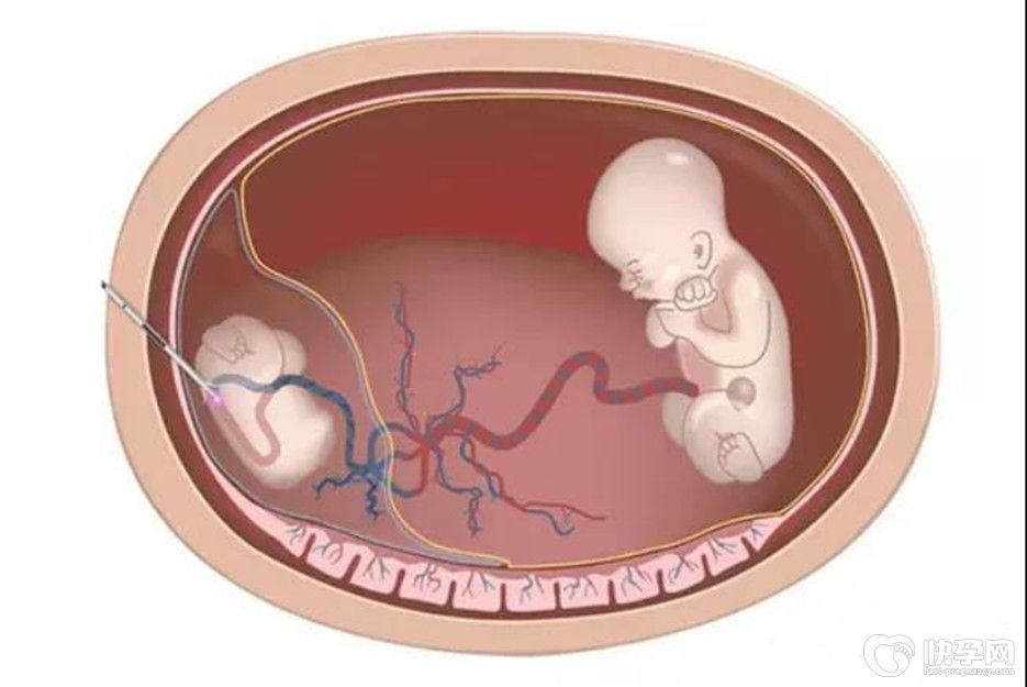 试管婴儿双胞胎减胎风险有哪些？了如指掌，才能胜券在握