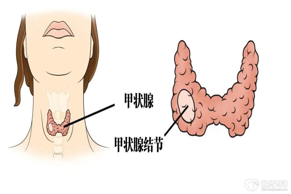盘点女性促甲状腺激素偏高的5个危害，早知早受益