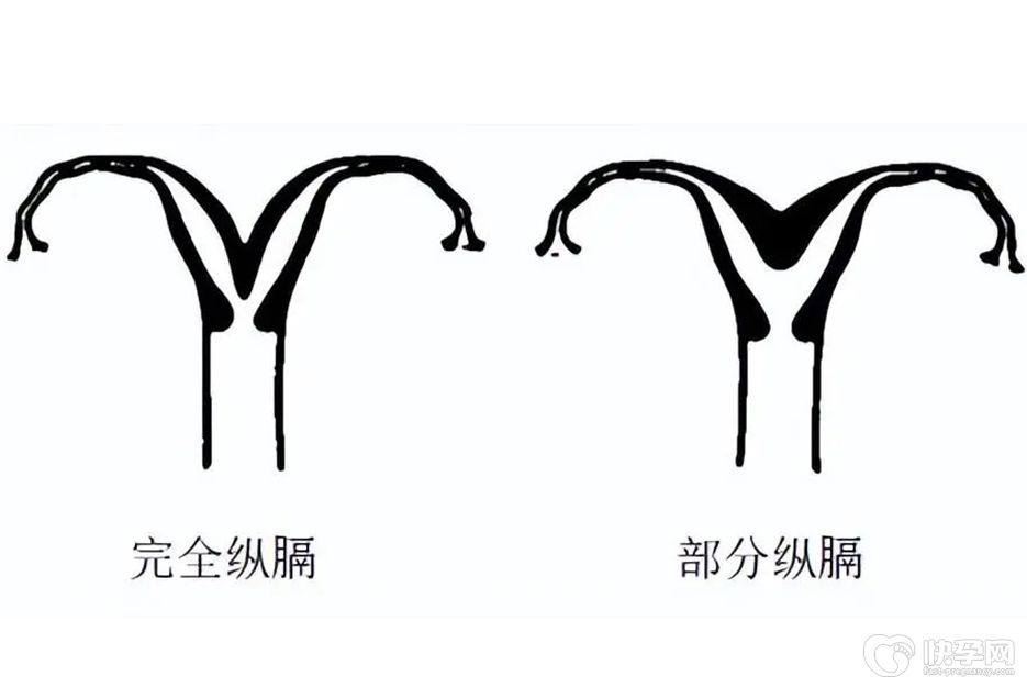 纵隔子宫可以做试管婴儿吗？专业意见告诉你该怎么办