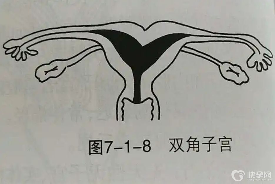 试管头条：32岁双角子宫致不孕，做试管婴儿能成功吗？