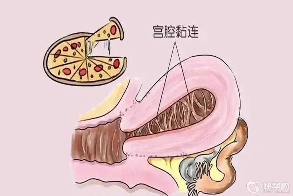 专题解析：宫腔粘连先治疗还是先取卵？三种方法治疗宫腔粘连