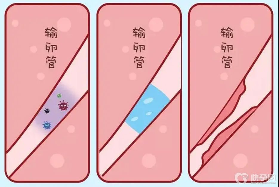 特别关注：输卵管堵塞不手术也可以怀孕呦！试管婴儿是不二之选