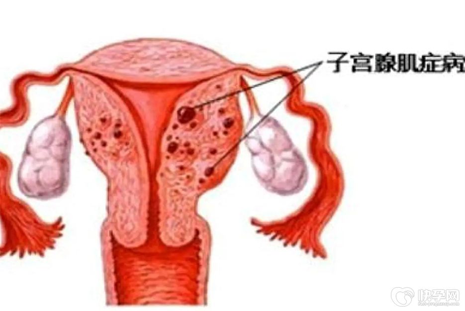 子宫腺肌症移植鲜胚还是冻胚好？看完你心中就有答案了