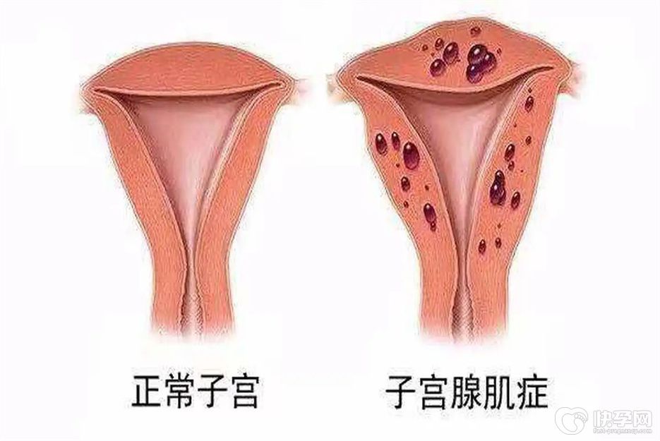 热点资讯：优思明能治疗轻度子宫腺肌症吗？听听生殖专家怎么说