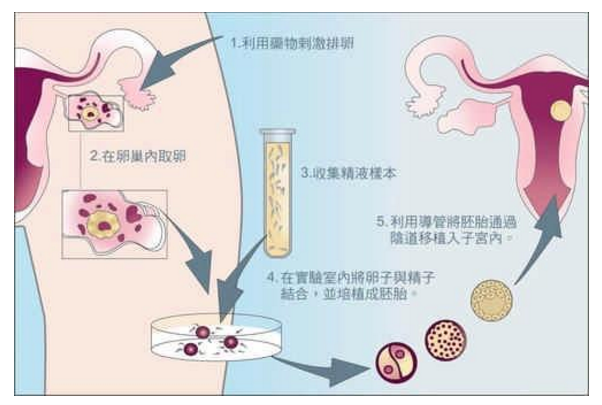 试管婴儿的全部流程，先看整体这四步