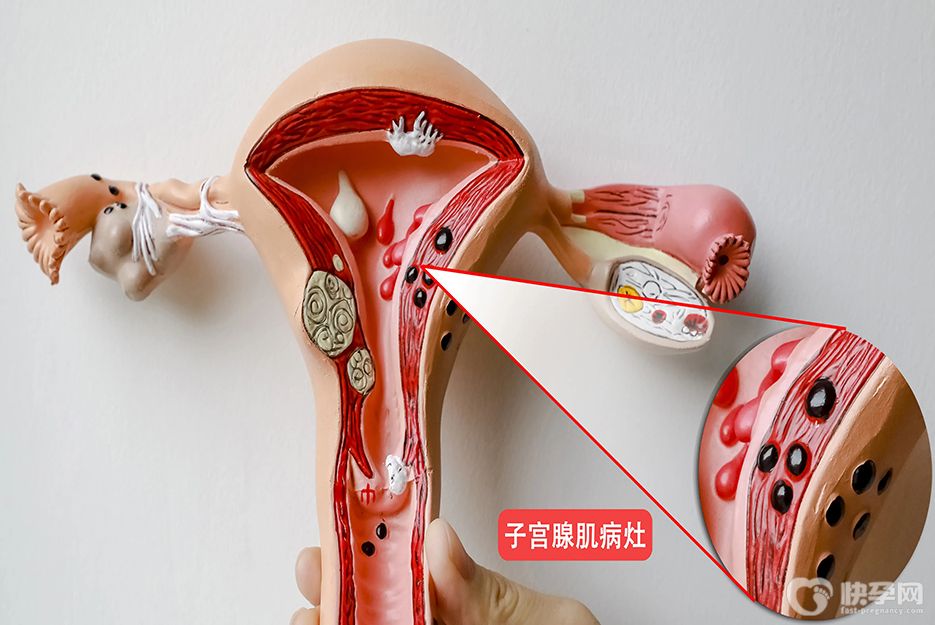 子宫腺肌症试管可以移植2个囊胚吗？3大风险值得重点关注