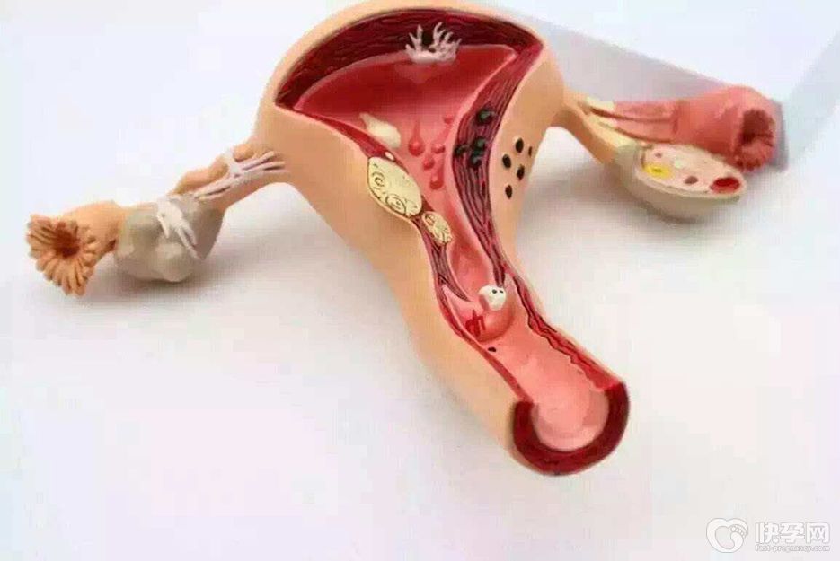 一文解析：子宫肌腺症能否做试管吗？试管成功率高吗？