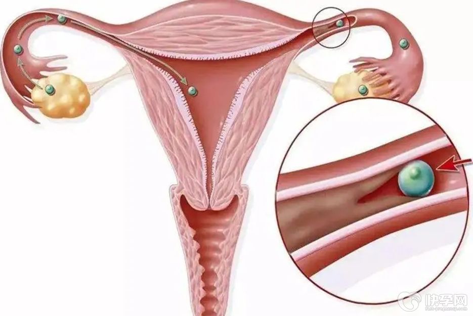 宫腔粘连可以做试管婴儿吗？正规治疗后成功率更可观