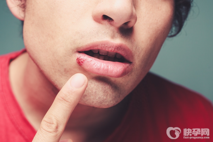 嘴上起泡是什么原因？一般都是这5个因素在作怪