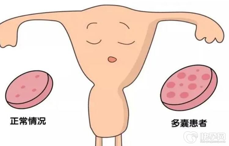 多囊做试管容易着床吗多少钱一次？