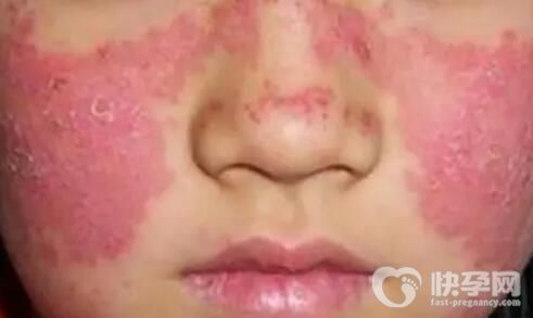 红斑狼疮对胎儿有什么影响？做试管费用要多少钱？