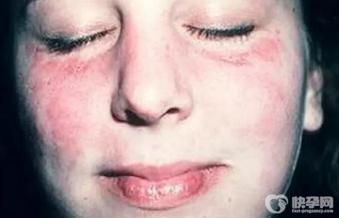 红斑狼疮能怀健康宝宝吗费用一般多少钱？