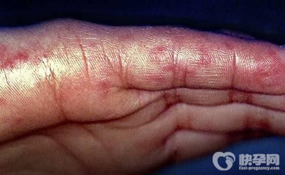 红斑狼疮试管移植后要打肝素吗？生育成功率高吗？