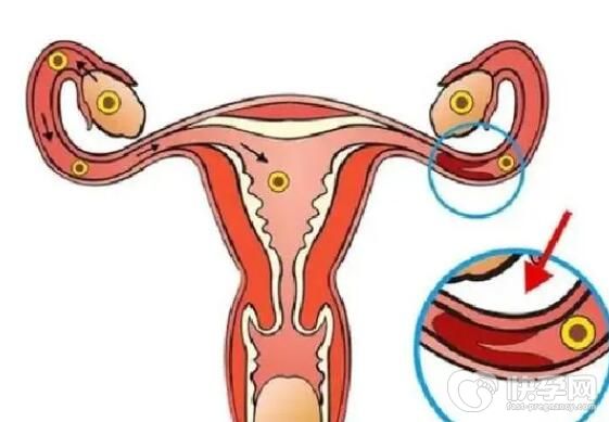 不全纵隔子宫会影响正常怀孕么能做试管吗？