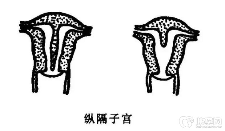 不全纵隔子宫多久可以试管移植成功？