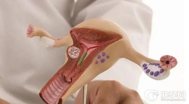 不全纵隔子宫试管移植不着床成功率高吗？